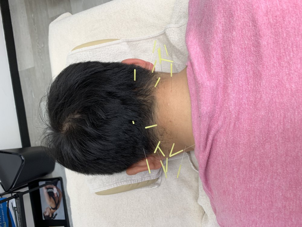 症例：トレーニング中に発生した首の痛み